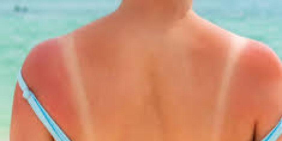 Sunburn Challenge, the dangerous fashion that exposes young people to risks. The Calabrian psychologist Marco Piccolo: "Wound as an act of rebellion"