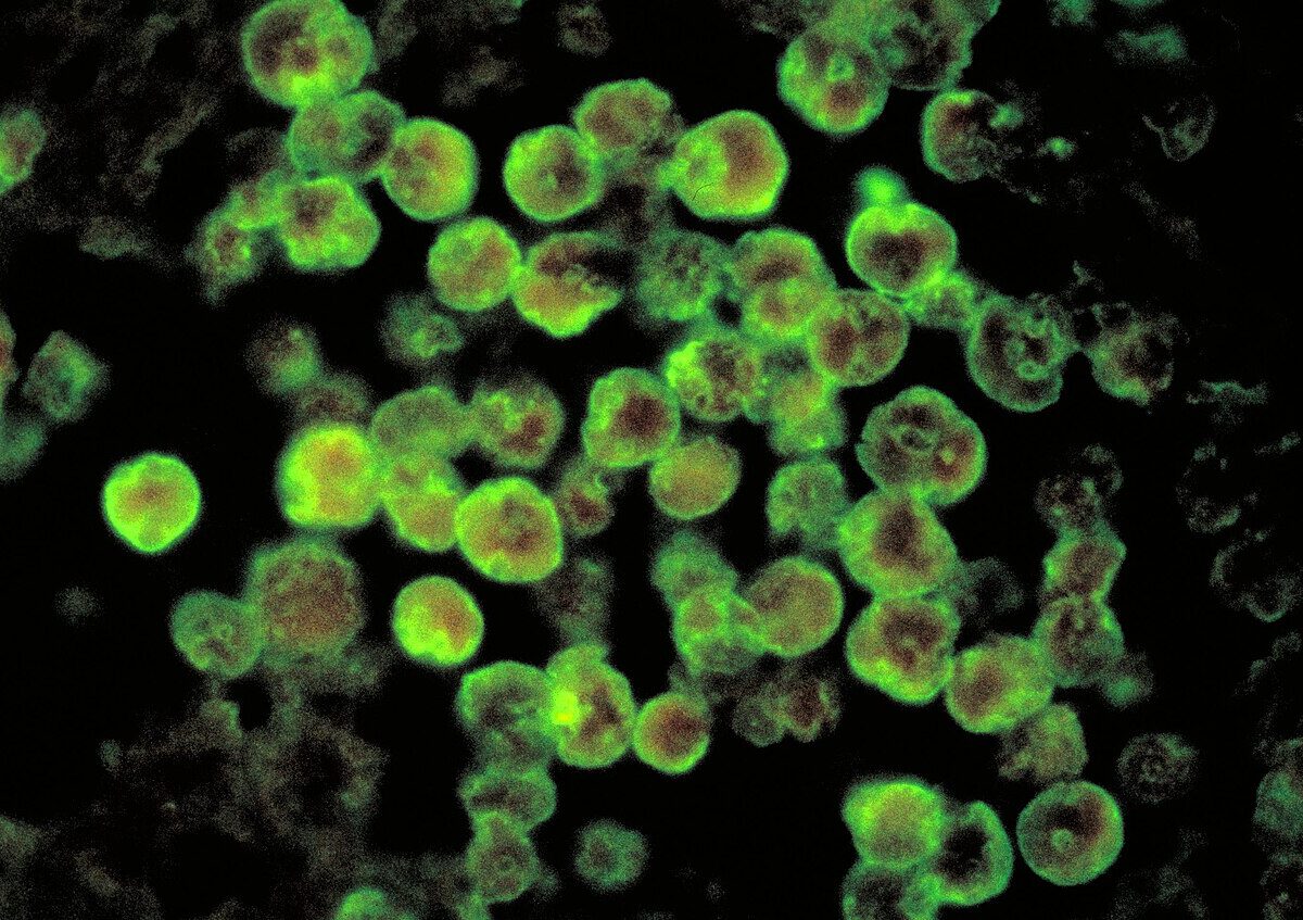Méningo-encéphalite_amibienne_primitive, brain-eating amoeba